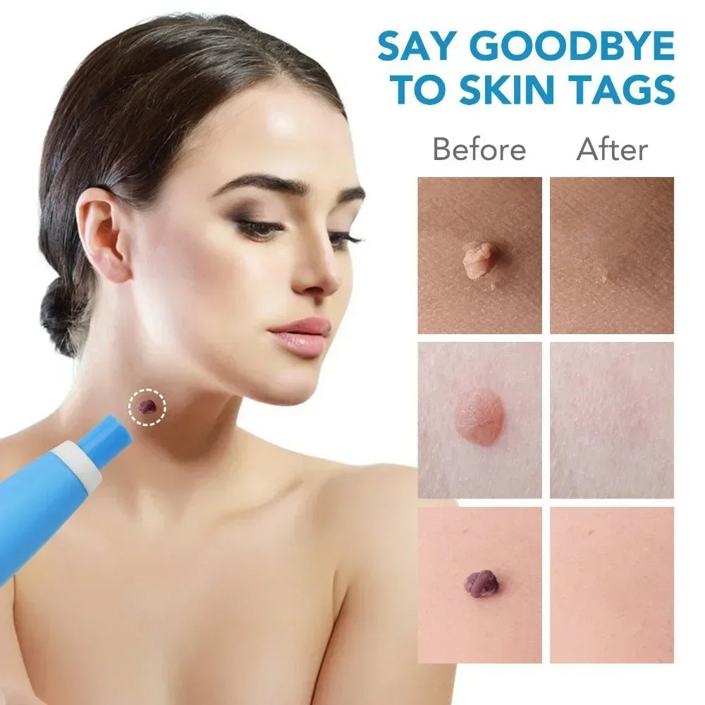 Auto Skin tag remover kit